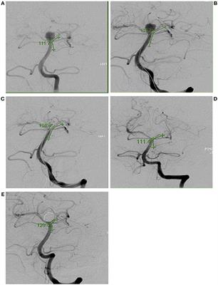 Endosurgical Remodeling of Wide-Necked Bifurcation Aneurysms